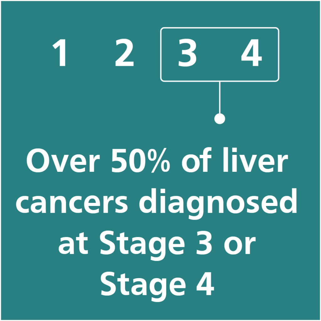 Over 50% of liver cancers diagnosed at Stage 3 or Stage 4